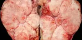 PLEOMORPHIC SARCOMA
