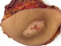 ISCHEMIC FASCIITIS