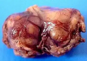 SCHWANNOMA