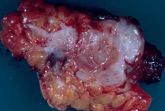 FIBROSARCOMA