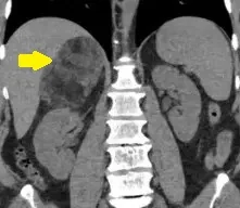 MYELOLIPOMA