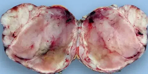 MYXOID LIPOSARCOMA