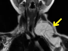 LIPOBLASTOMA