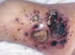 ANGIOSARCOMA