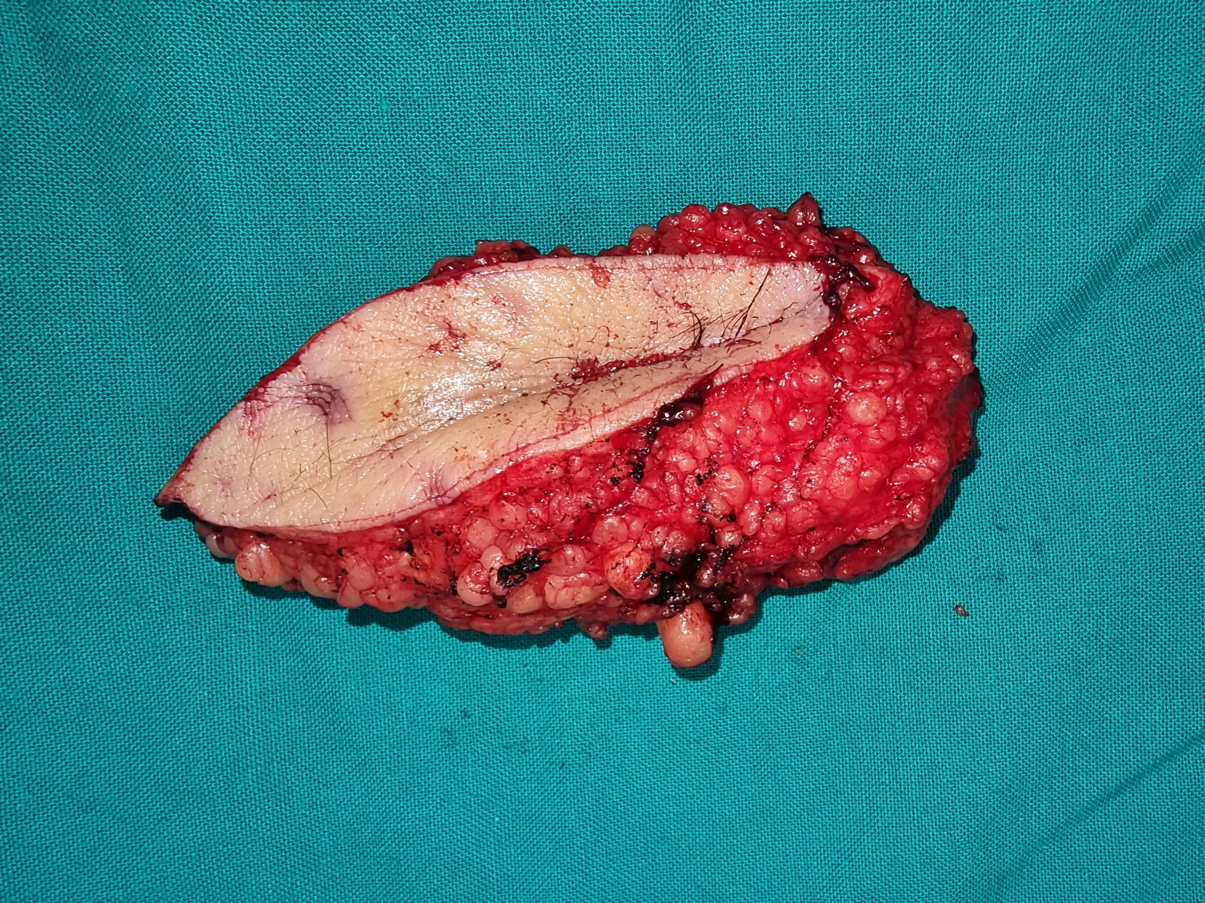 EXCISION OF PILONIDAL SINUS