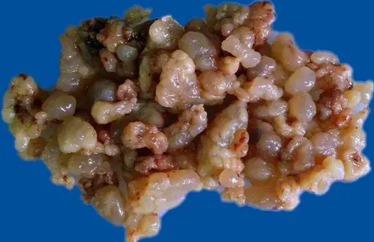 BOTRYOID RHABDOMYOSARCOMA