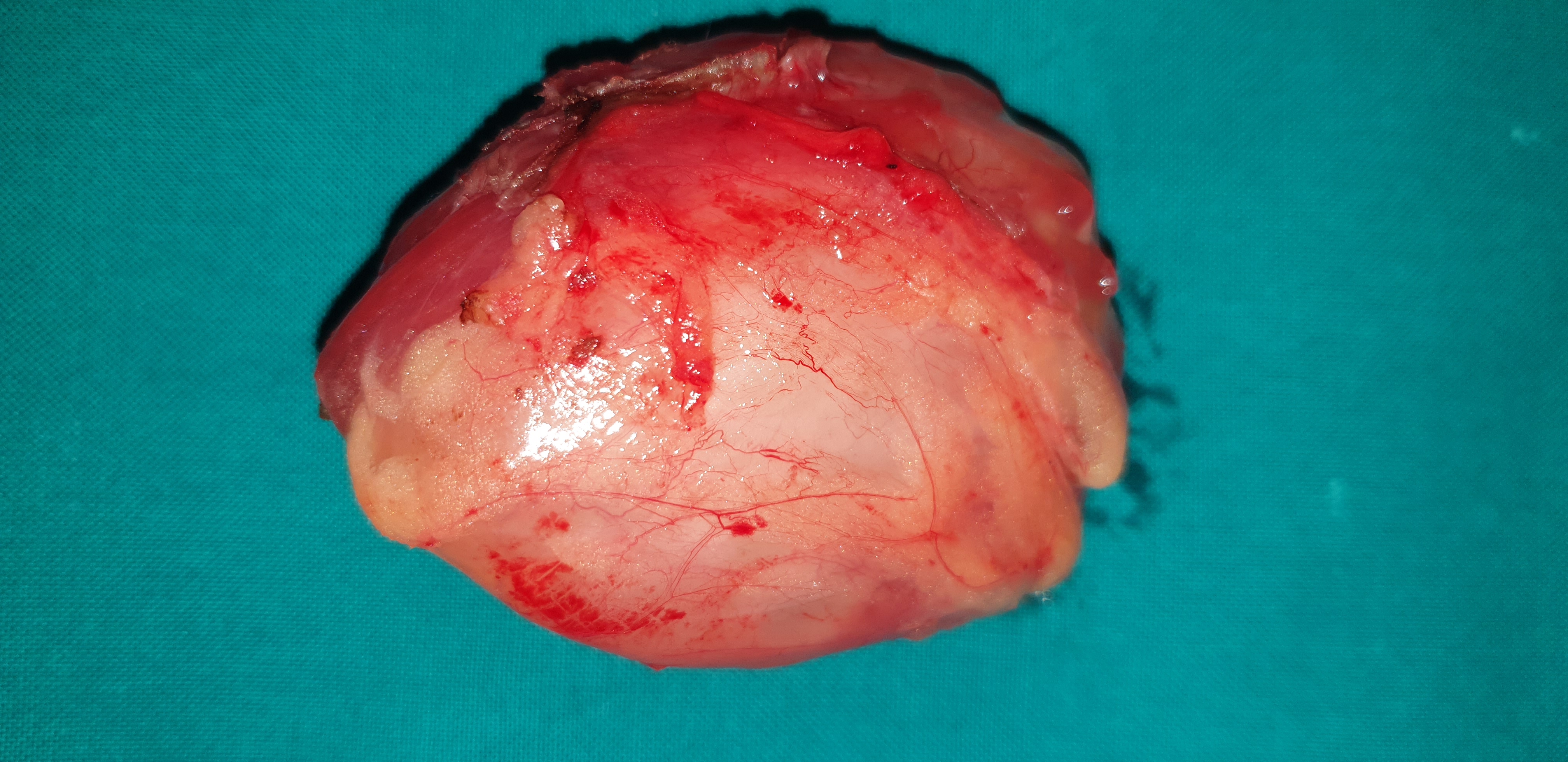 INTRAMUSCULAR MYXOMA