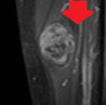 INTRAMUSCULAR MYXOMA