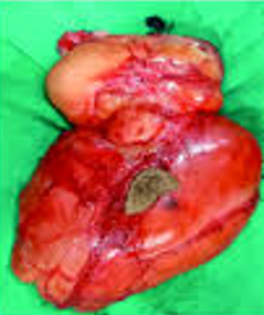 INTRAMUSCULAR MYXOMA