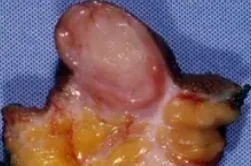 DERMATOFIBROSARCOMA PROTUBERANS