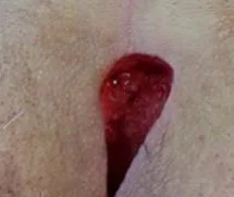 EXCISION OF PILONIDAL SINUS