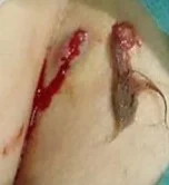 PILONIDAL ABSCESS
