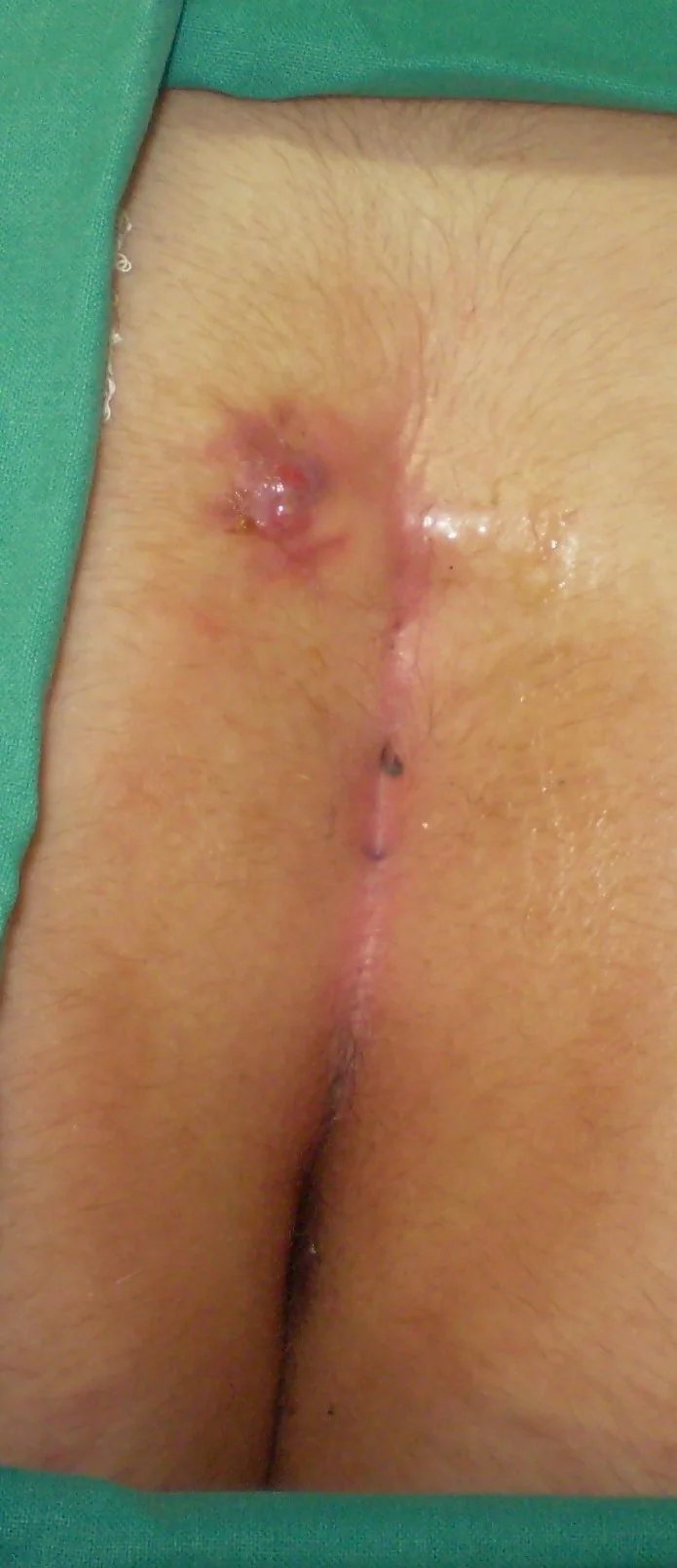 PILONIDAL SINUSES