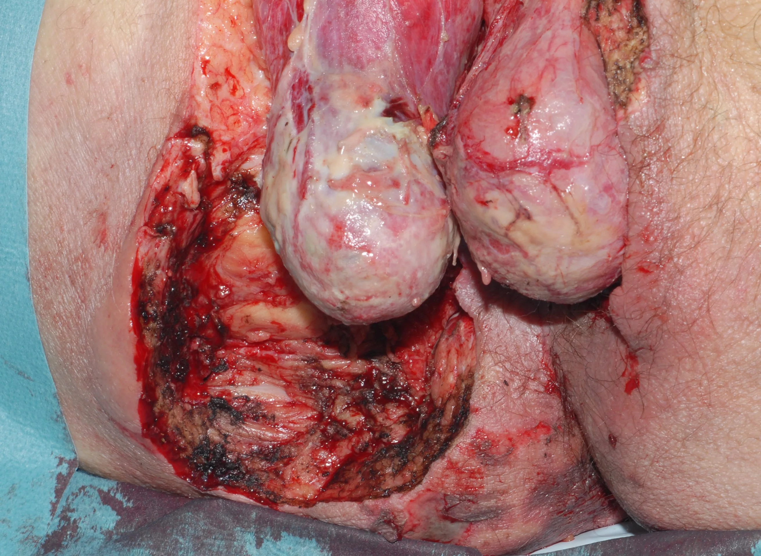 FOURNIER'S GANGRENE - SURGERY