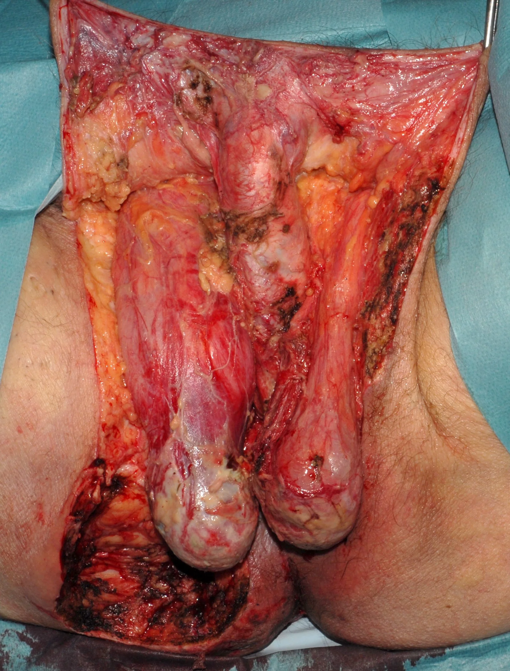 FOURNIER'S GANGRENE - SURGERY