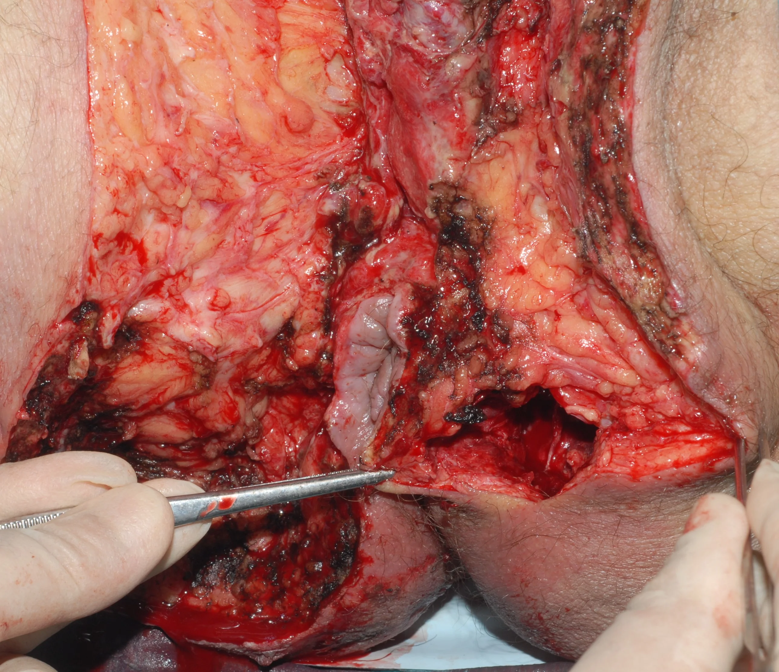 FOURNIER'S GANGRENE - SURGERY