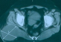 INTRAMUSCULAR MYXOMA