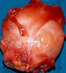 INTRAMUSCULAR MYXOMA