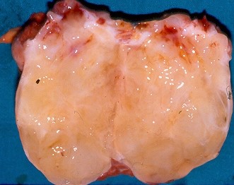 INTRAMUSCULAR MYXOMA