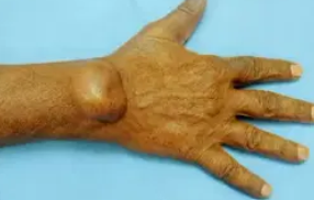 FIBROMA TENDON SHEATH