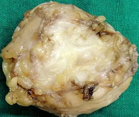 FIBROMA OF TENDON SHEATH