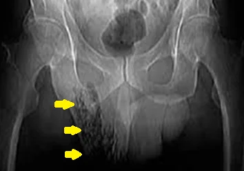 FOURNIER'S GANGRENE - AIR IN THE SCROTUM