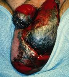 FOURNIER'S GANGRENE
