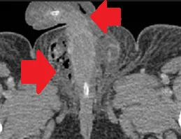 FOURNIER'S GANGRENE - AIR IN THE SCROTUM