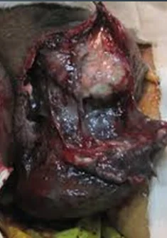 FOURNIER'S GANGRENE