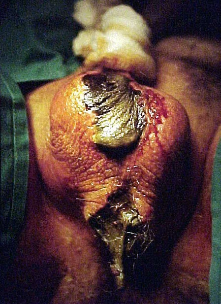 FOURNIER'S GANGRENE