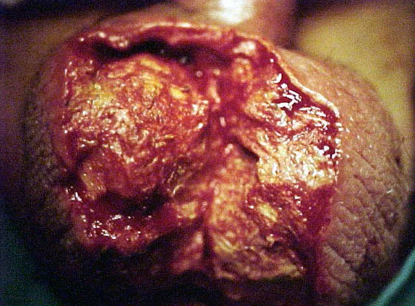 FOURNIER'S GANGRENE
