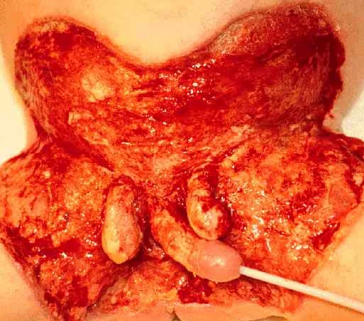 FOURNIER'S GANGRENE - SURGERY