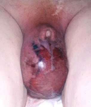 FOURNIER'S GANGRENE