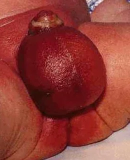 FOURNIER'S GANGRENE 
