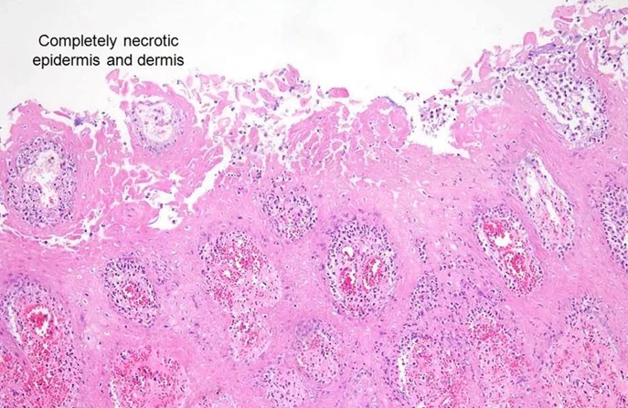 FOURNIER'S GANGRENE