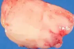 GANGLIONEUROMA
