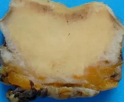 GRANULAR CELL TUMOR