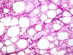 LIPOMA - FAT NECROSIS