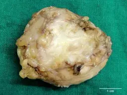 FIBROMA TENDON SHEATH