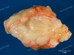 LIPOMA