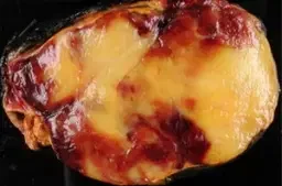 MYELOLIPOMA