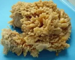 LIPOMA ARBORESCENS