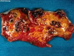 ANGIOSARCOMA