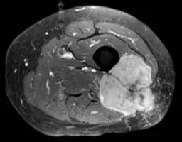PLEOMORPHIC SARCOMA