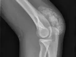 TUMORAL CALCINOSIS
