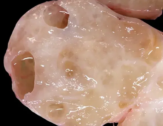 INTRAMUSCULAR MYXOMA