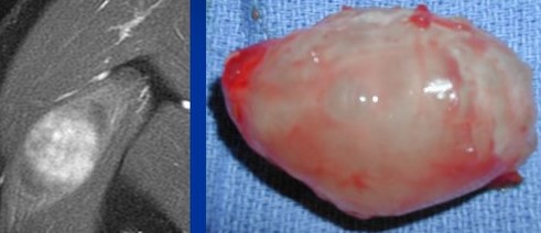INTRAMUSCULAR MYXOMA