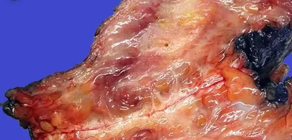 ISCHEMIC FASCIITIS