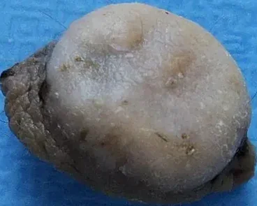 JUVENILE XANTHOGRANULOMA