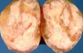 LEIOMYOMA 